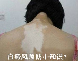 白癜风图片 白癜风危害图片